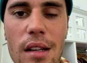 Justin Bieber's face paralyzed (Image: Instagram)