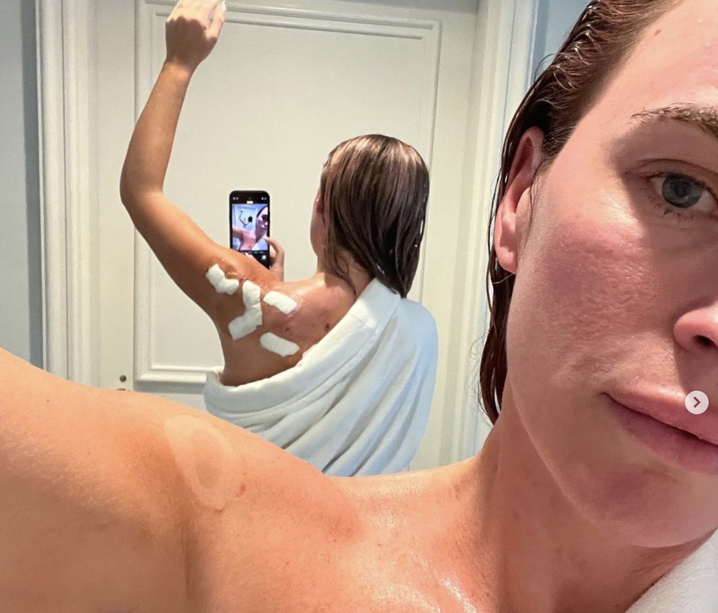 Teddi Mellencamp shows surgical scars after undergoing surgery to remove melanomas (Image: Instagram)