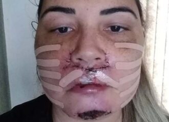 Brazilian Instagram model Mariana Michelini needs reconstructive surgery (Image: Instagram)