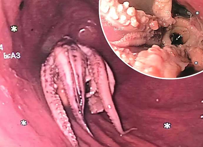 Doctor's photos of octopus lodged in man's throat (Image: Twitter)