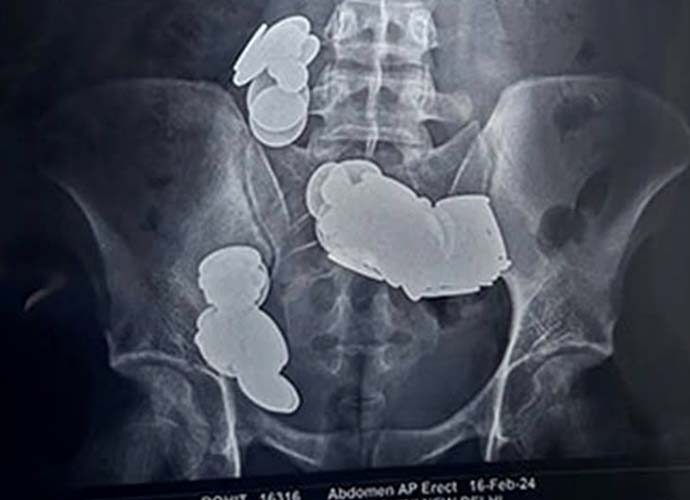 X-ray of weightlifter who swallowed 39 coins (Image: Sir Ganga Ram Hospital)
