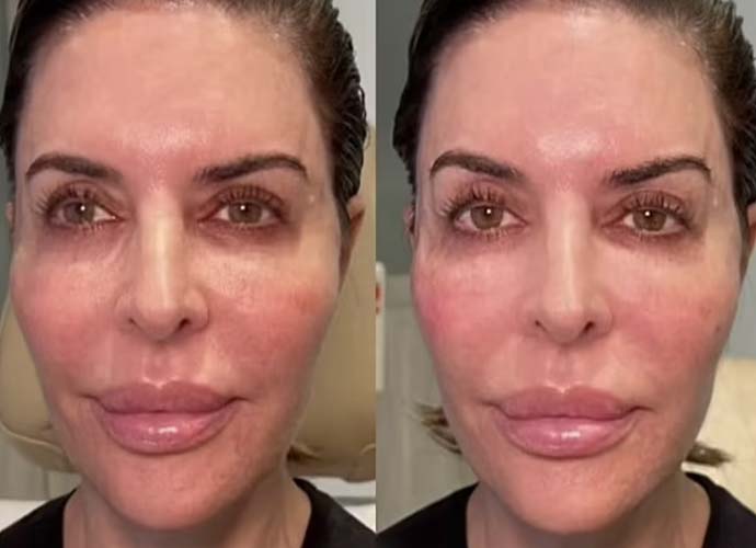Lisa Rinna shows of before-and-after face procedure (Image: Instagram)